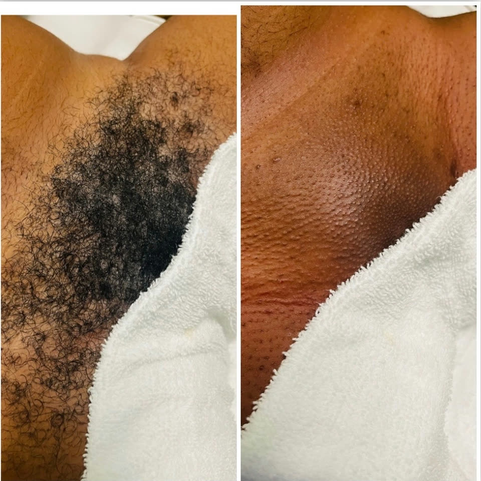 Before and after results of the Send Nudes Brazilian underarm wax